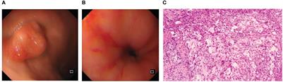 Case report: A case study of neoadjuvant immunochemotherapy for locally advanced esophageal squamous carcinoma